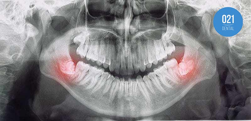 O que fazer quando o dente do siso começar a doer?