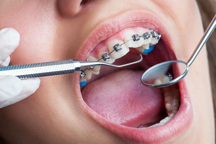 Avaliação dos dentes com aparelho ortodôntico
