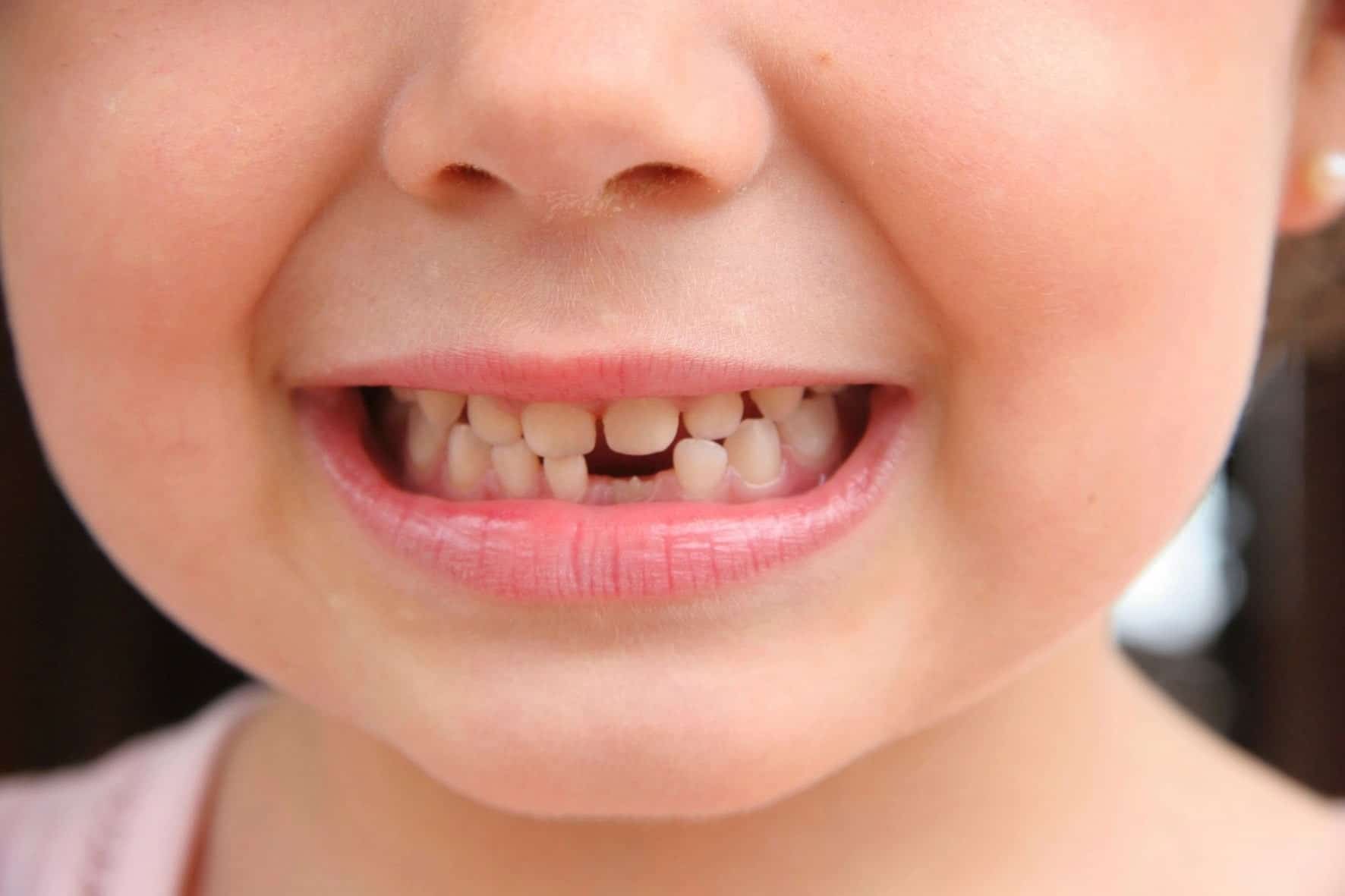 imagem de uma criança com dentes faltando