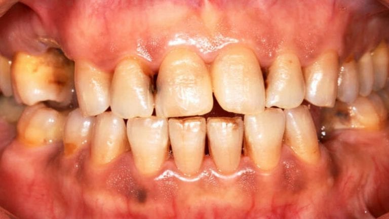 imagem ilustrativa de dentes podres