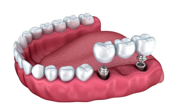 Benefícios do Implante Dentário