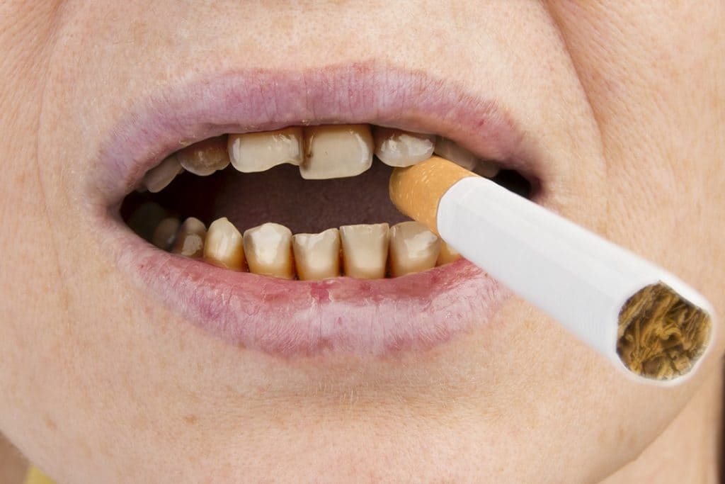 cigarro causa amarelamento dos dentes