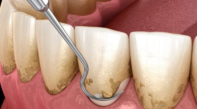 placa bacteriana no dente