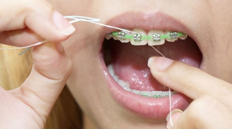 Como usar fio dental com aparelho ortodôntico