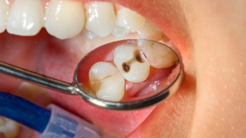 Dente com cárie visto pelo espelho do dentista