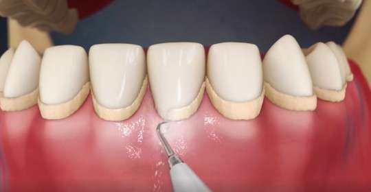 placa bactariana sendo removida do dente