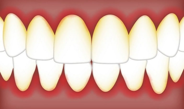 dentes com gengiva inflamada causada pela gengivite e periodontite