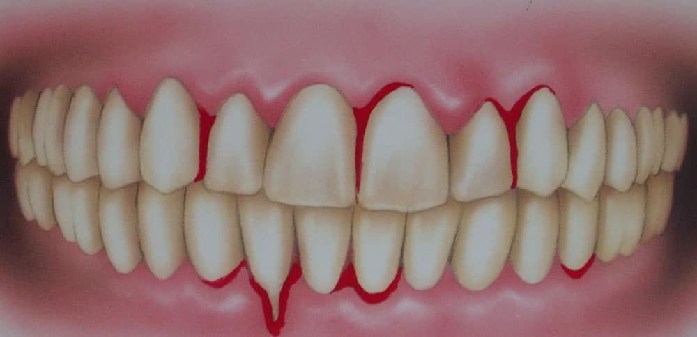 dentes com sangramento gengival