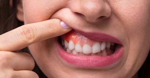 Sinais de Alerta para Dentes e Gengivas