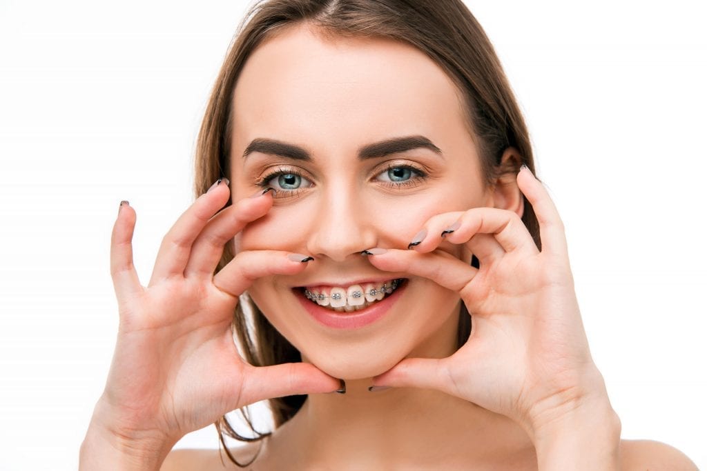 mulher jovem sorrindo com aparelho ortodontico na boca
