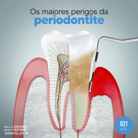 os maiores perigos da periodontite