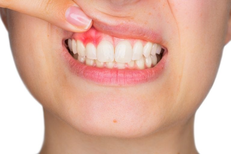 dentes com periodontite