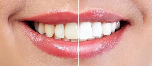 dentes clareados vs dentes sem clareamento