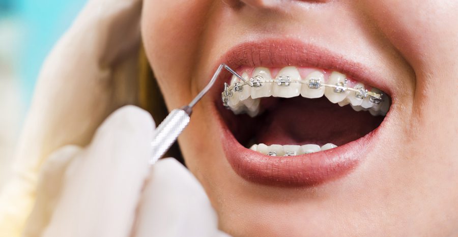 dentista avaliando dentes de mulher com aparelho dentário
