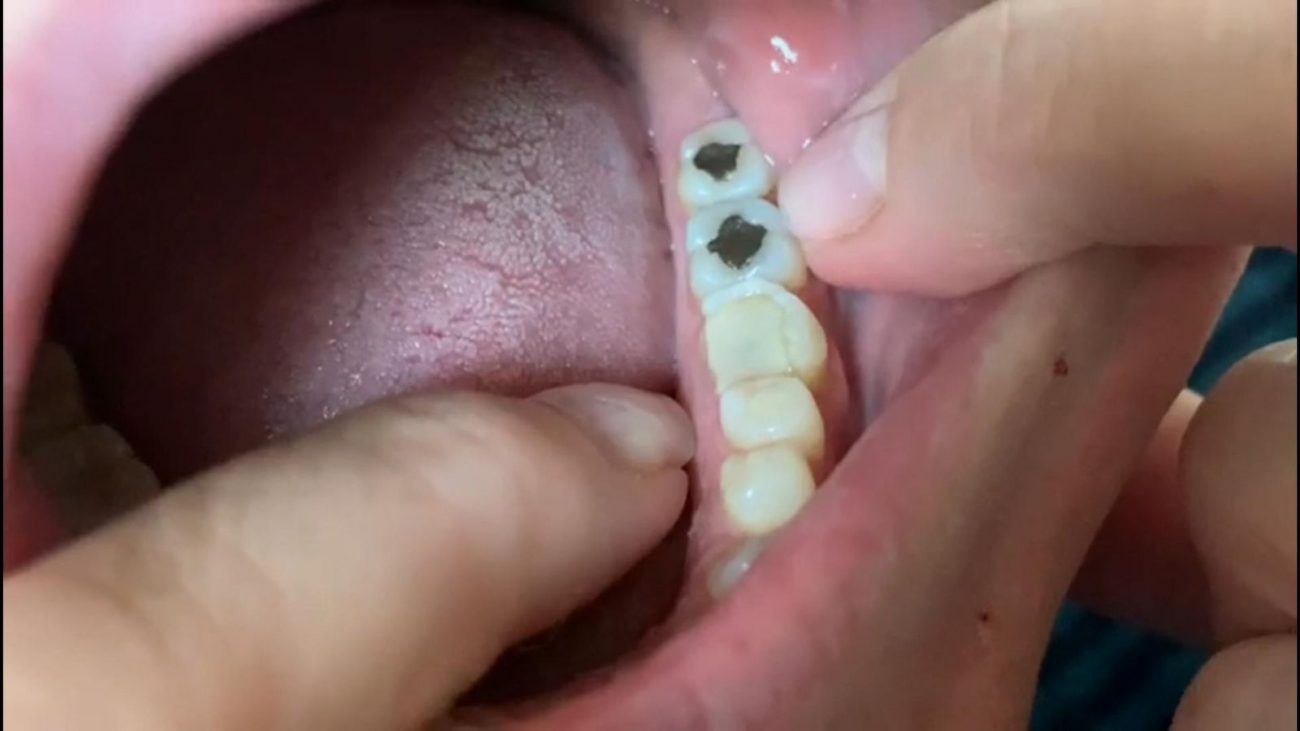 obturação dente sensível