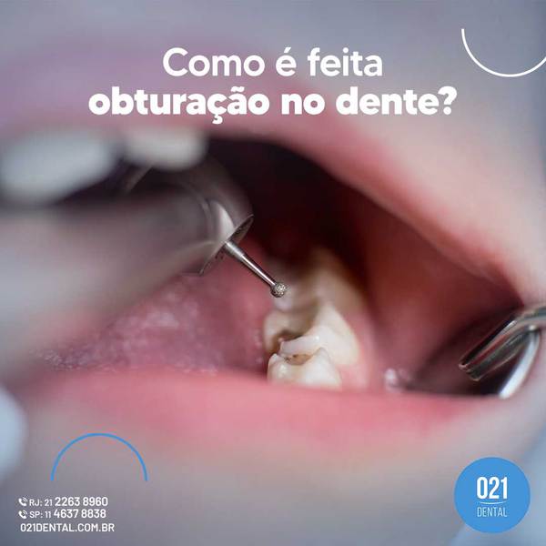 Como é feita obturação no dente?