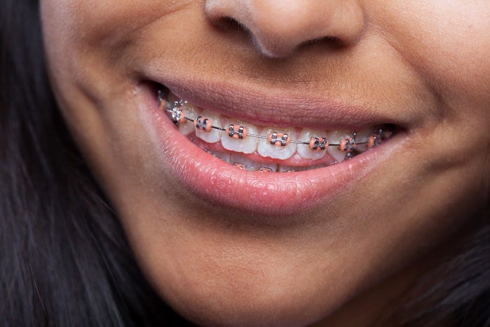 Mulher sorrindo com aparelho ortodontico e mau hálito