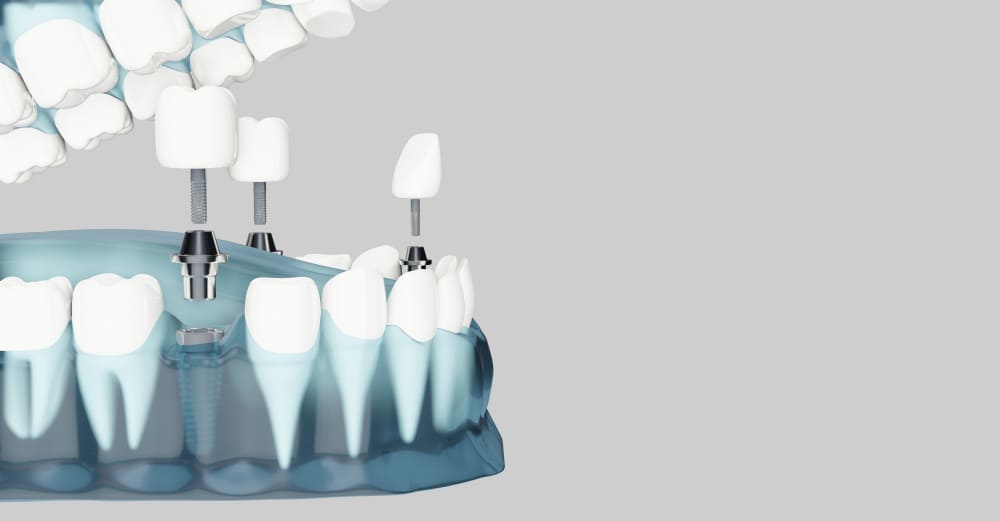 Quais as etapas para colocar o implante dentário