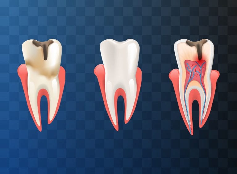 Saiba tudo sobre o tratamento de canal dental
