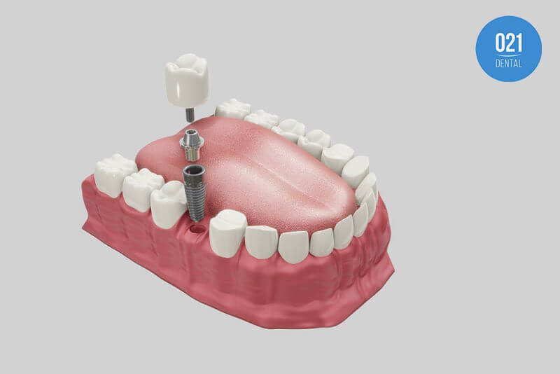 Por que existem diferentes tipos de implantes dentários?
