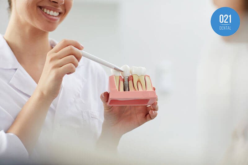 Lista: os 5 principais tipos de implantes dentários
