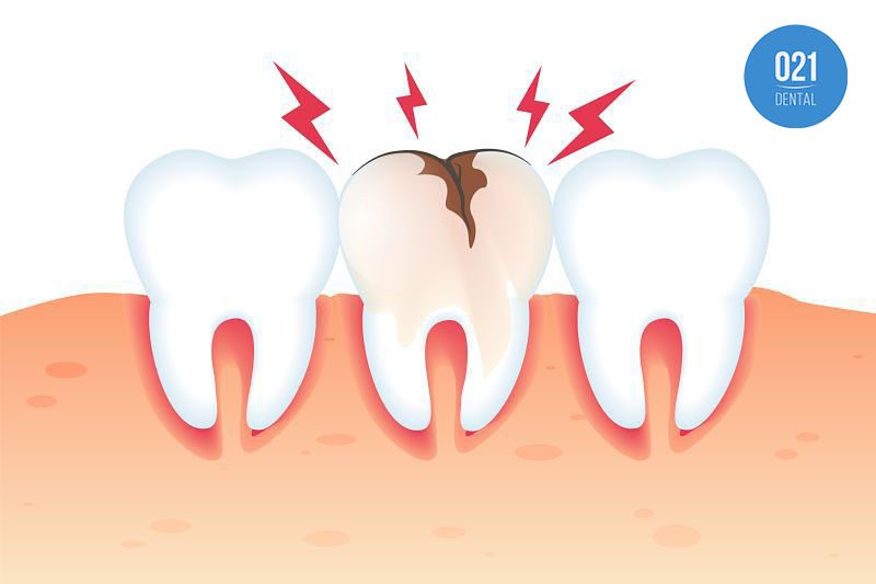 Dentes quebrando: conheça os principais motivos