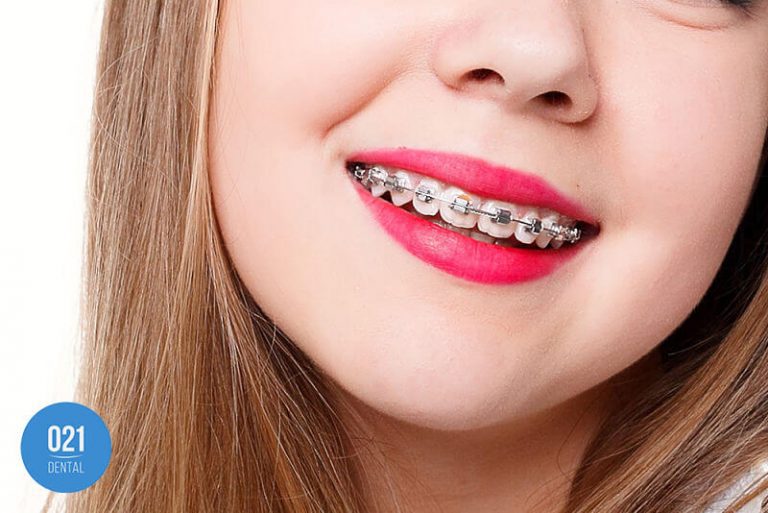 Dentes tortos: conheça os possíveis tratamentos