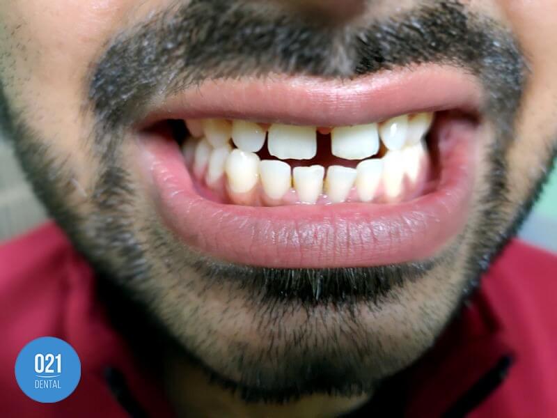 Homem com Diastema nos dentes frontais superiores