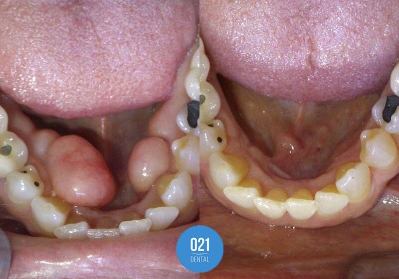 Duas imagens lado a lado comparando o paciente antes e depois da remoção do tórus mandibular