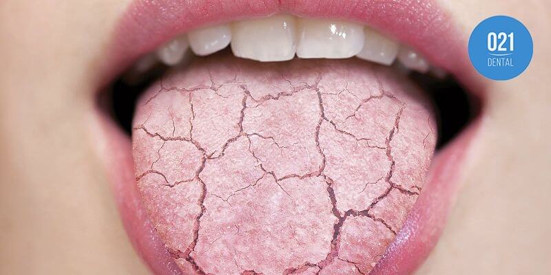 Imagem ilustrativa de língua cheia de rachaduras para representar o sintoma da boca seca