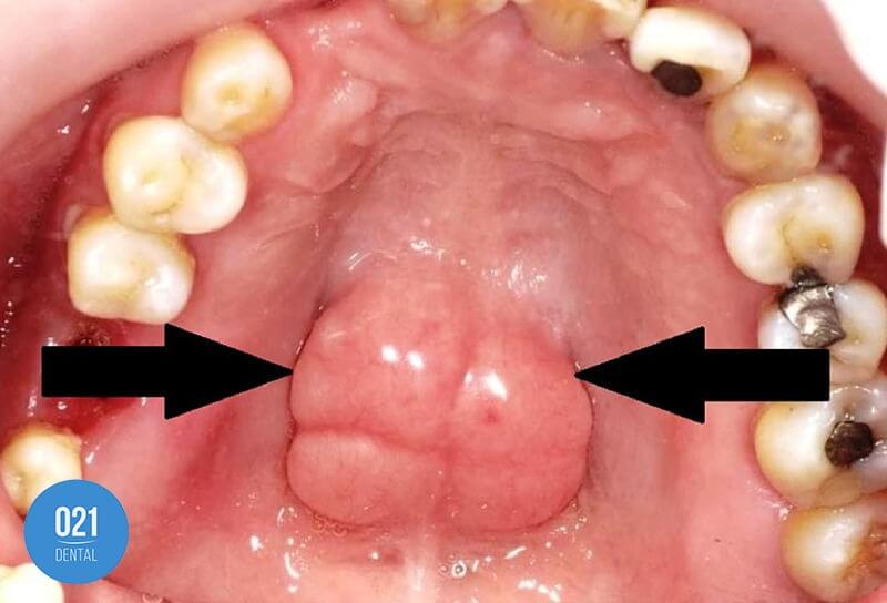 Imagem de boca do paciente dando destaque para o crescimento de um tórus palatino no céu da boca