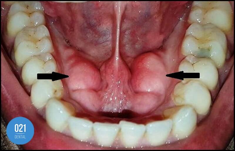 Fotografia de boca de paciente com indicações que mostram o crescimento do tórus na região da mandíbula