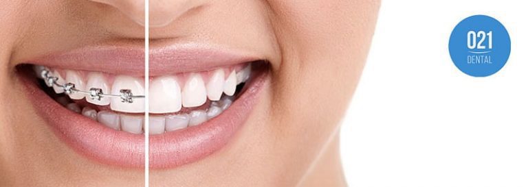Imagem comparativa de dentes com e sem o aparelho de porcelana