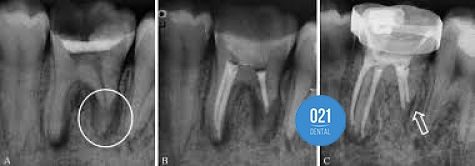 3 imagens de raio x demonstrando as lesões na polpa do dente