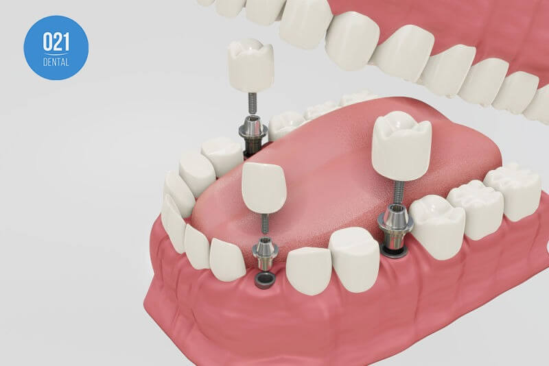 implante dentário como solução da agenesia