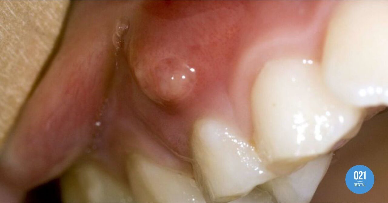 Bolha na gengiva, o que pode ser? 5 Principais Causas