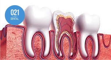 ilustração demonstrando dente que necessita do tratamento de canal