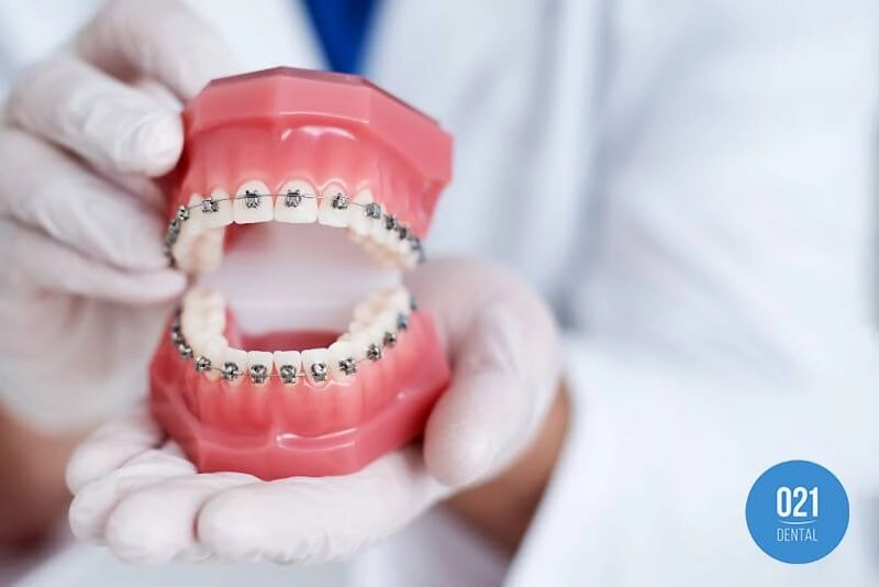 Imagem de um protótipo de arcada dentária com aparelho ortodontico