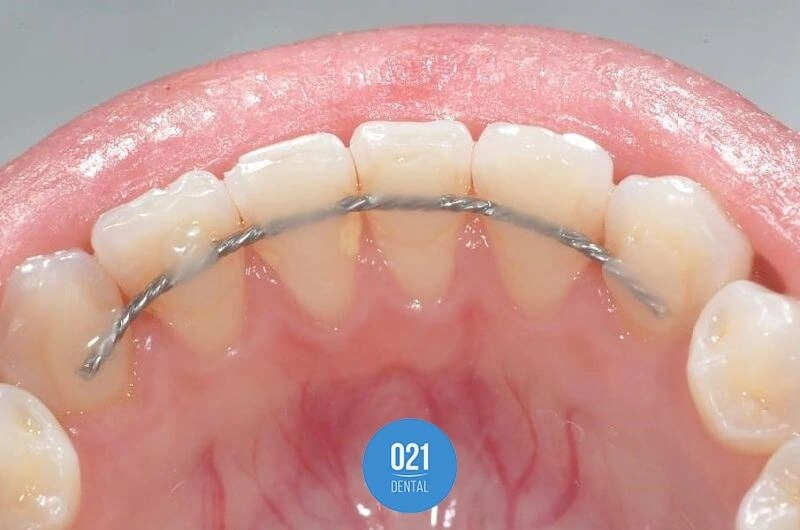 Imagem da parte interna da arcada dentária superior com contenção