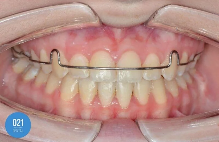 Dentes com um aparelho de contenção na arcada superior
