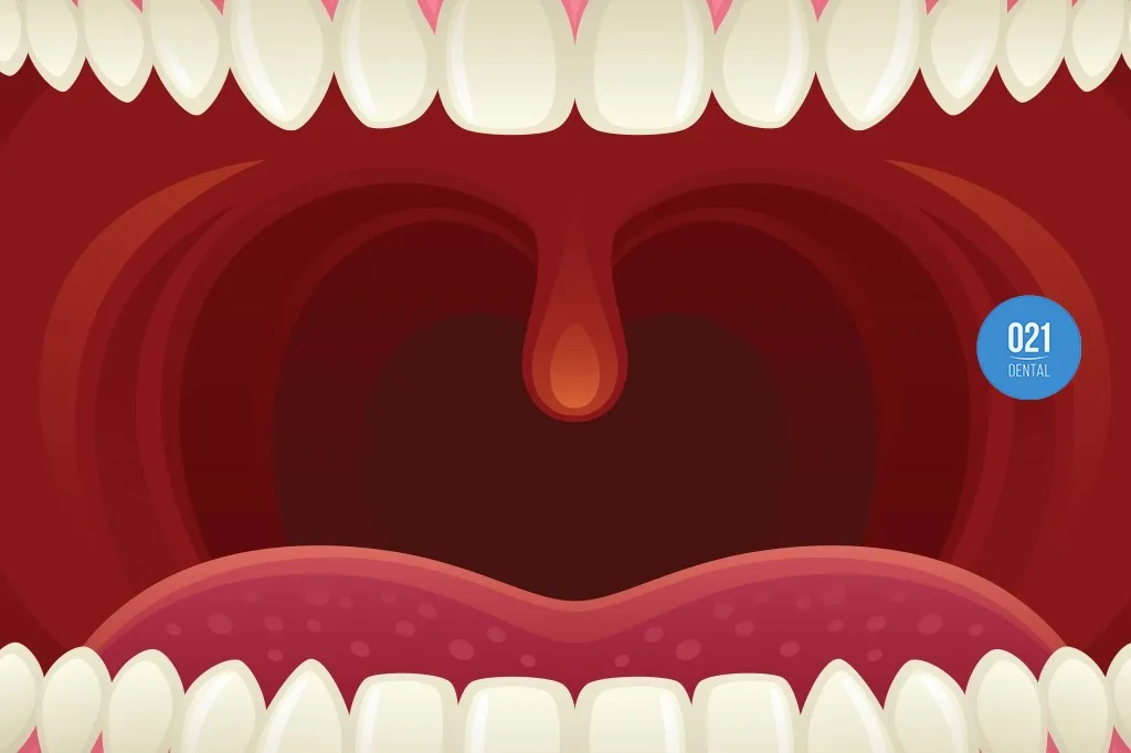 Conteúdo imagético com desenho gráfico da parte interna de uma boca mostrando a úvula, ou seja, o sininho do céu da boca