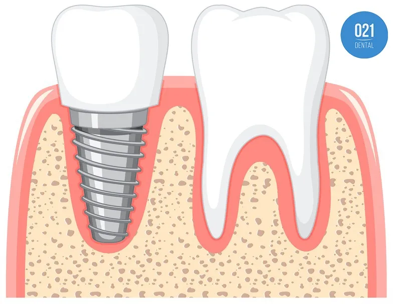 Desenho da parte interna de dois dentes sendo um com raiz saudável e outro com um pino de implante dentário