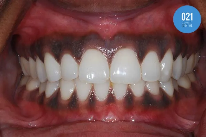 Imagem de uma arcada dentária com a gengiva escura