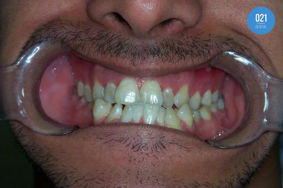 Imagem de uma boca masculina com os dentes tortos 