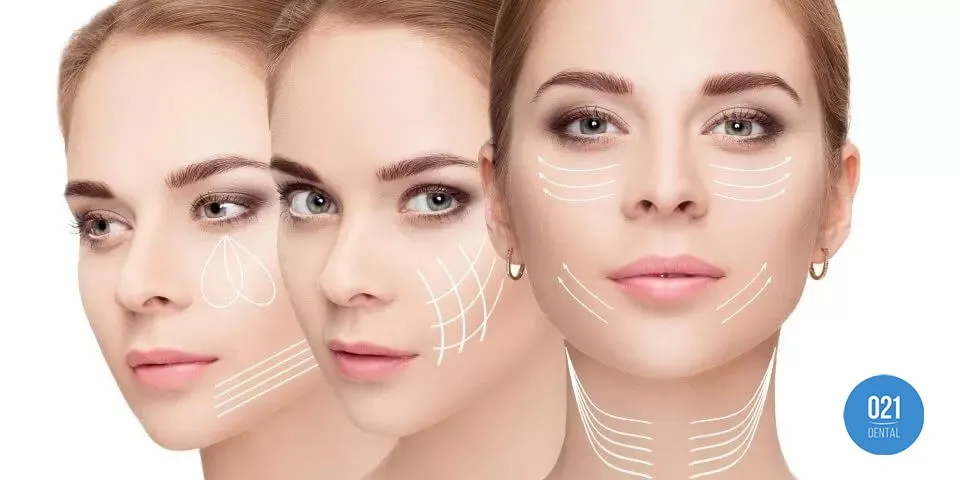 Imagem de três mulheres com marcações no rosto para implantação de fios de pdo