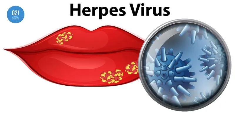 Ilustração de uma boca com herpes e uma representação do vírus Herpes Simplex