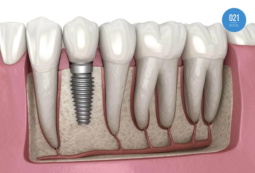 Ilustração de parte da arcada dentária com um implante dentário mostrado até o pino e seis dentes aparecendo até a raiz