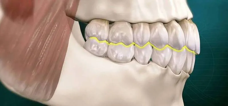 Visão lateral da arcada dentária superior e inferior