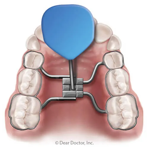 Imagem do palato e arcada dentária superior com o aparelho para abrir o céu da boca