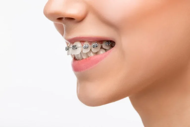 Visão lateral de uma boca sorrindo. É possível ver os dentes com aparelho ortodôntico fixo.